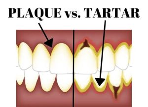 Plaque vs. Tartar: What’s the Difference? Plaque vs. Tartar: What’s the Difference?