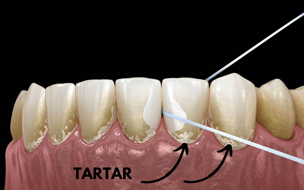 Plaque vs. Tartar: What’s the Difference?