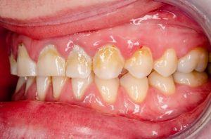 What Happens If Plaque Is Left on Your Teeth? What Happens If Plaque Is Left on Your Teeth?