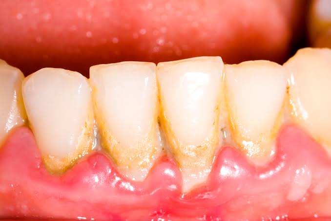 What Is Dental Plaque and Why Does It Build Up?