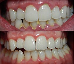 What Is Dental Plaque and Why Does It Build Up?