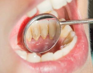 Why Plaque Is More Than Just a Cosmetic Problem