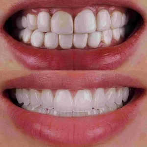 How to Choose the Right Type of Veneers How to Choose the Right Type of Veneers