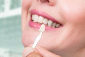 Questions to Ask Your Dentist Before Getting Veneers Questions to Ask Your Dentist Before Getting Veneers