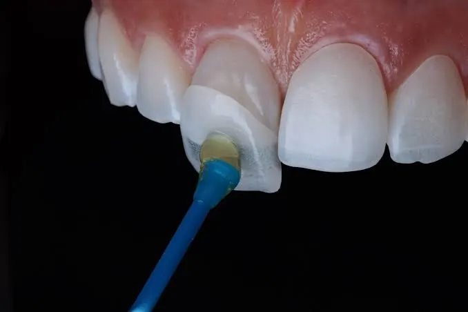 Questions to Ask Your Dentist Before Getting Veneers