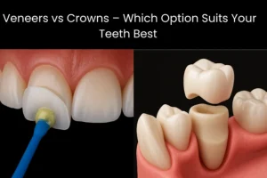Veneers vs Crowns: Which Is Right for Your Smile? Veneers vs Crowns: Which Is Right for Your Smile?