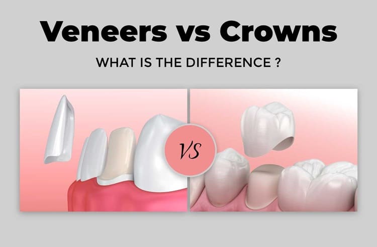 Veneers vs Crowns: Which Is Right for Your Smile?