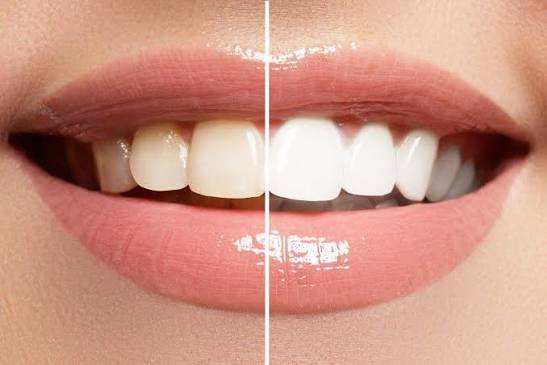 Veneers vs Teeth Whitening: Which Should You Choose?