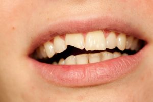 10 Things You Should Know Before Getting a Tooth Cap