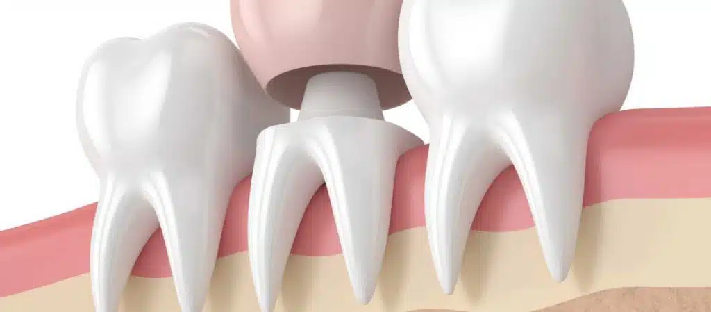 10 Things You Should Know Before Getting a Tooth Cap