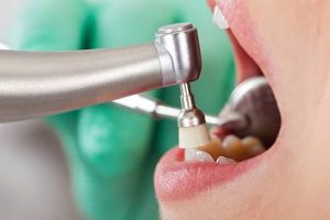 7 Benefits of Getting Your Teeth Professionally Cleaned