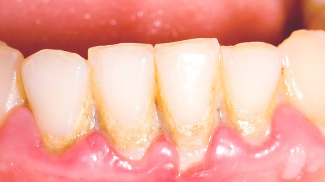 A Daily Routine for Keeping Plaque Under Control