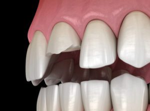 Are Dental Caps Worth It? Pros, Cons, and Considerations