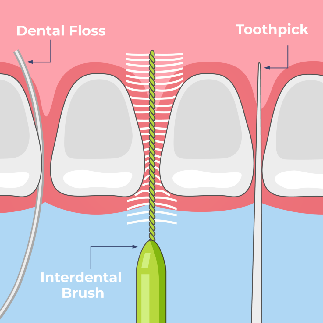 Flossing and Plaque: How Interdental Cleaning Helps