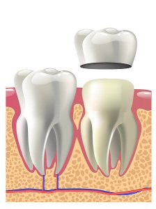 How Do Dental Caps Work, and When Do You Need One?