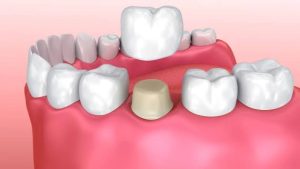How Long Do Teeth Caps Last? A Guide to Their Lifespan