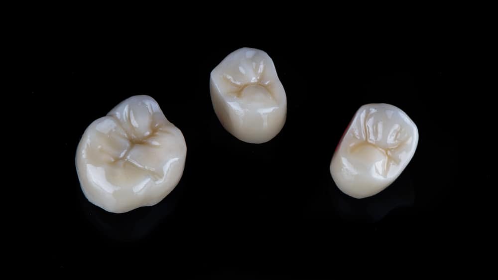 How Long Do Teeth Caps Last? A Guide to Their Lifespan