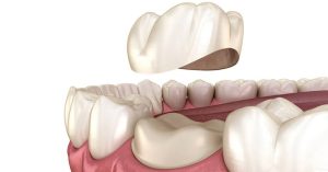 Tooth Caps Explained: Types, Benefits, and Costs Tooth Caps Explained: Types, Benefits, and Costs