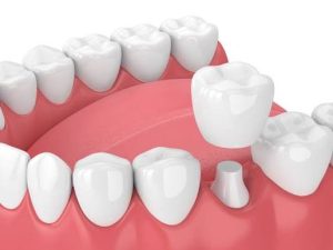 What Are Teeth Caps? A Complete Guide to Dental Crowns