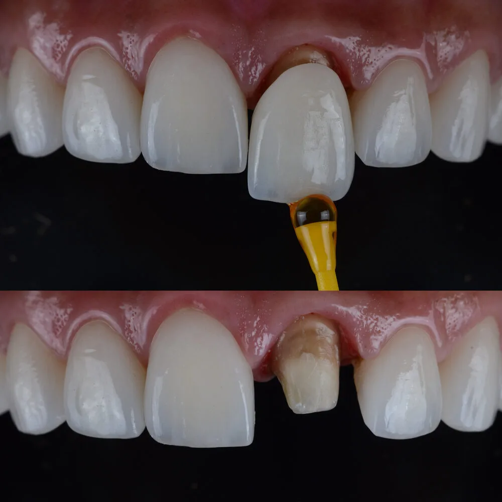 What Are Teeth Caps? A Complete Guide to Dental Crowns